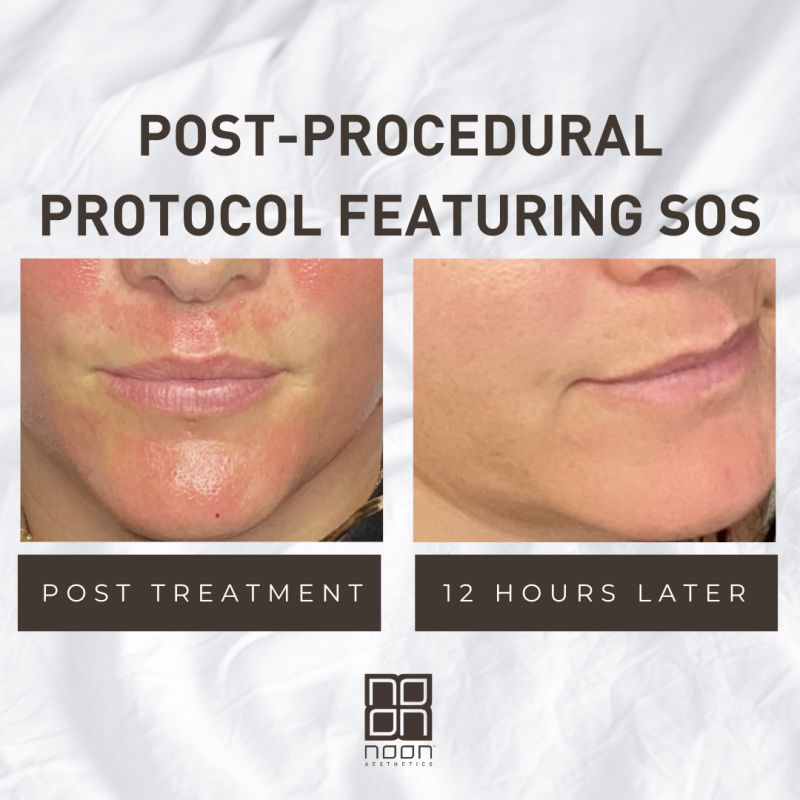NOON SOS okliuzinis veido kremas, 50ML - Image 2